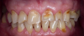 Dental consultation for tooth replacement